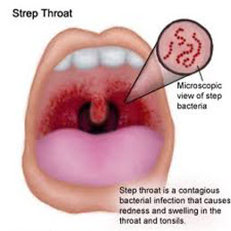 Step Throat Bacteria