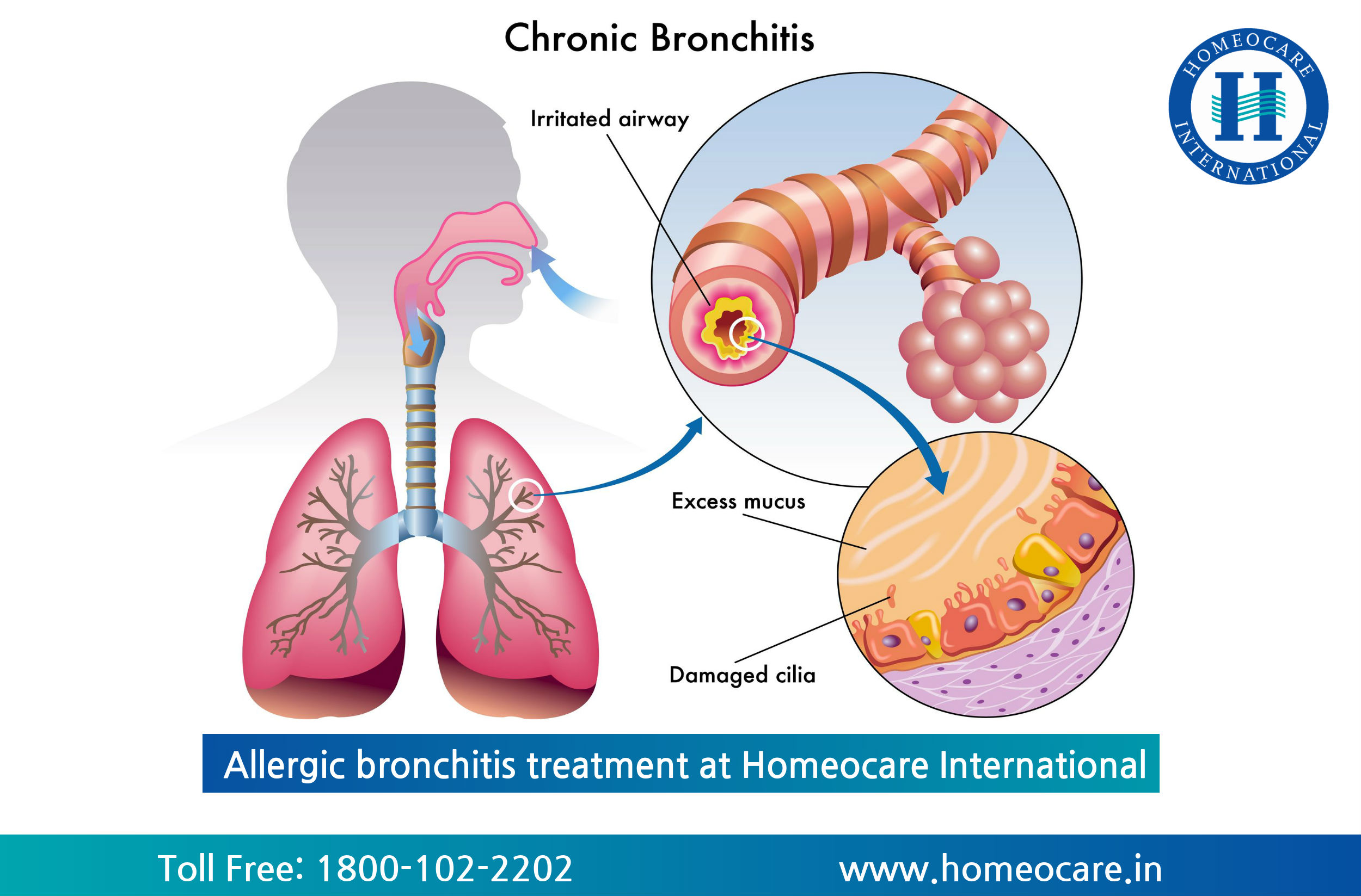 Allergic bronchitis treatment at Homeocare International