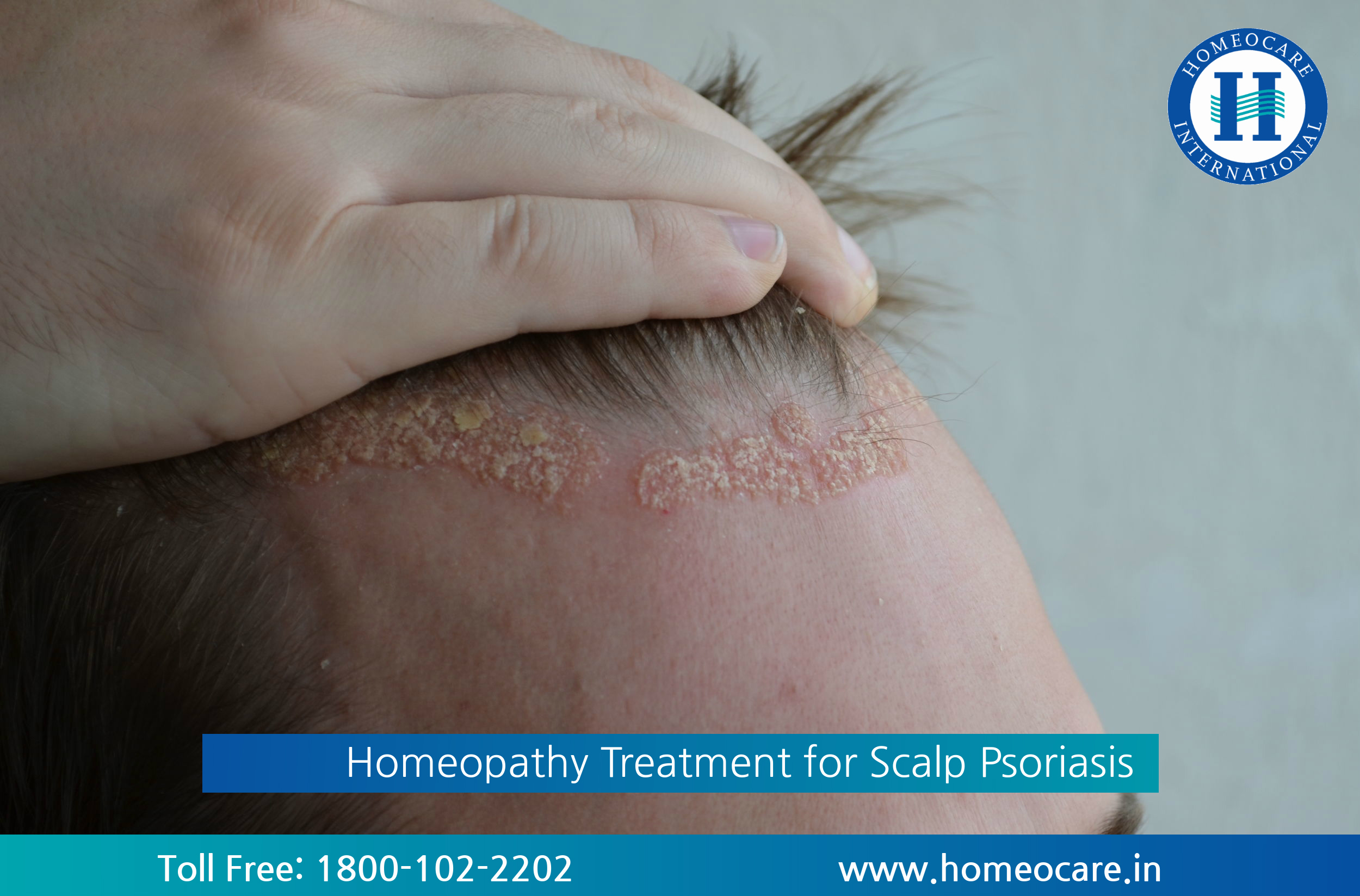 Homeopathy Treatment for Scalp Psoriasis