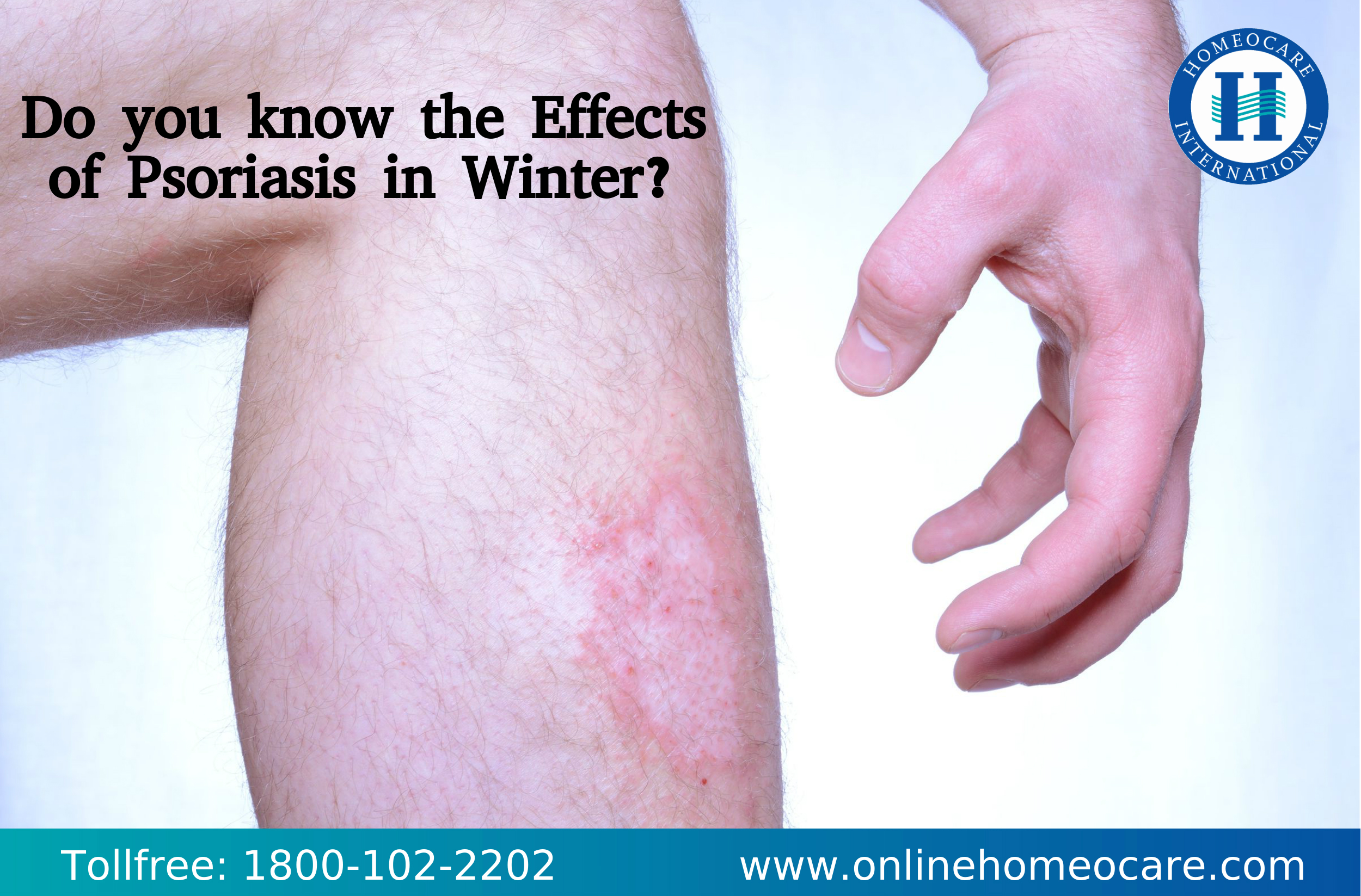 Psoriasis effects in winter