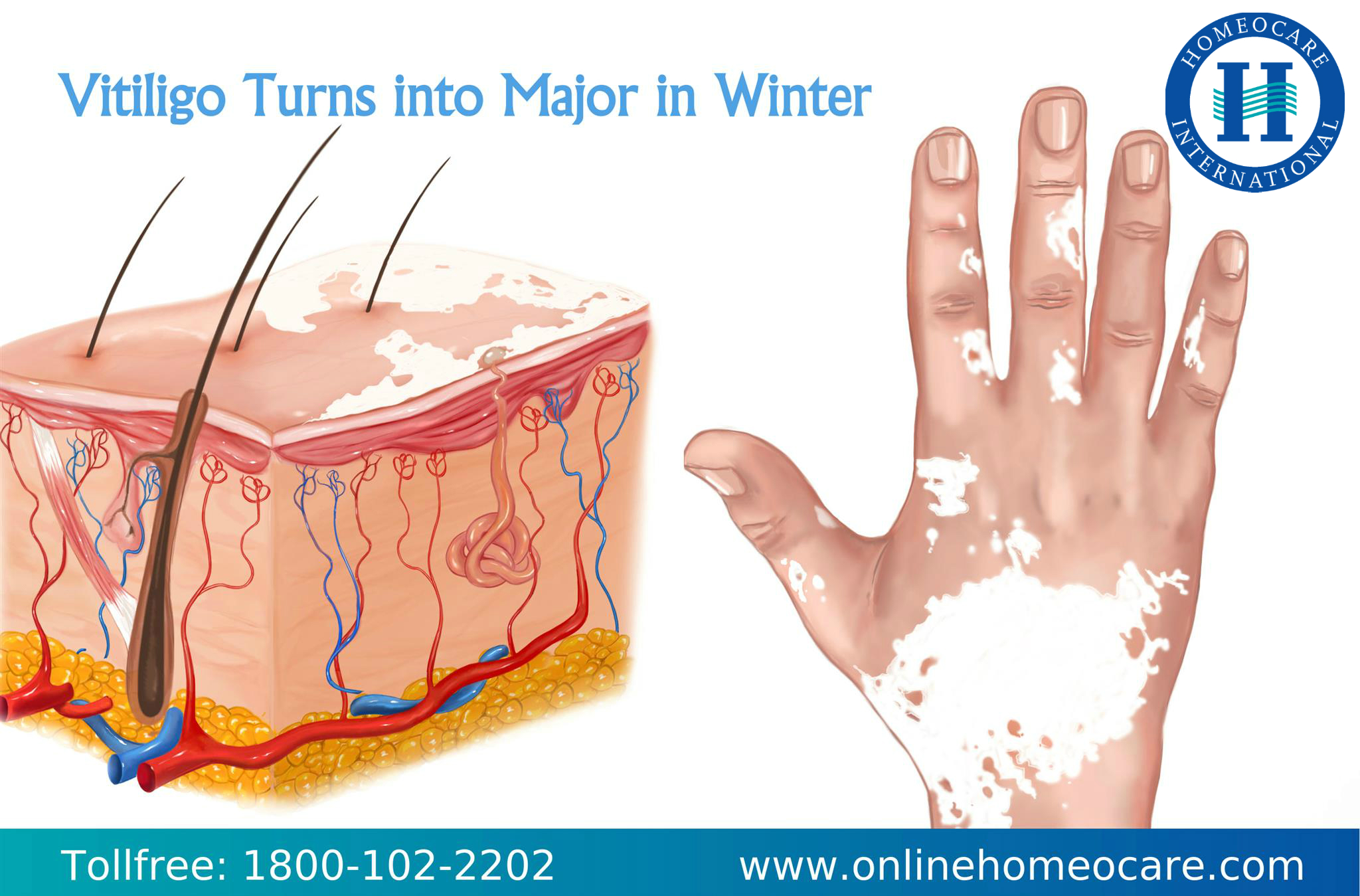 Homeopathy Treatment for Vitiligo problems