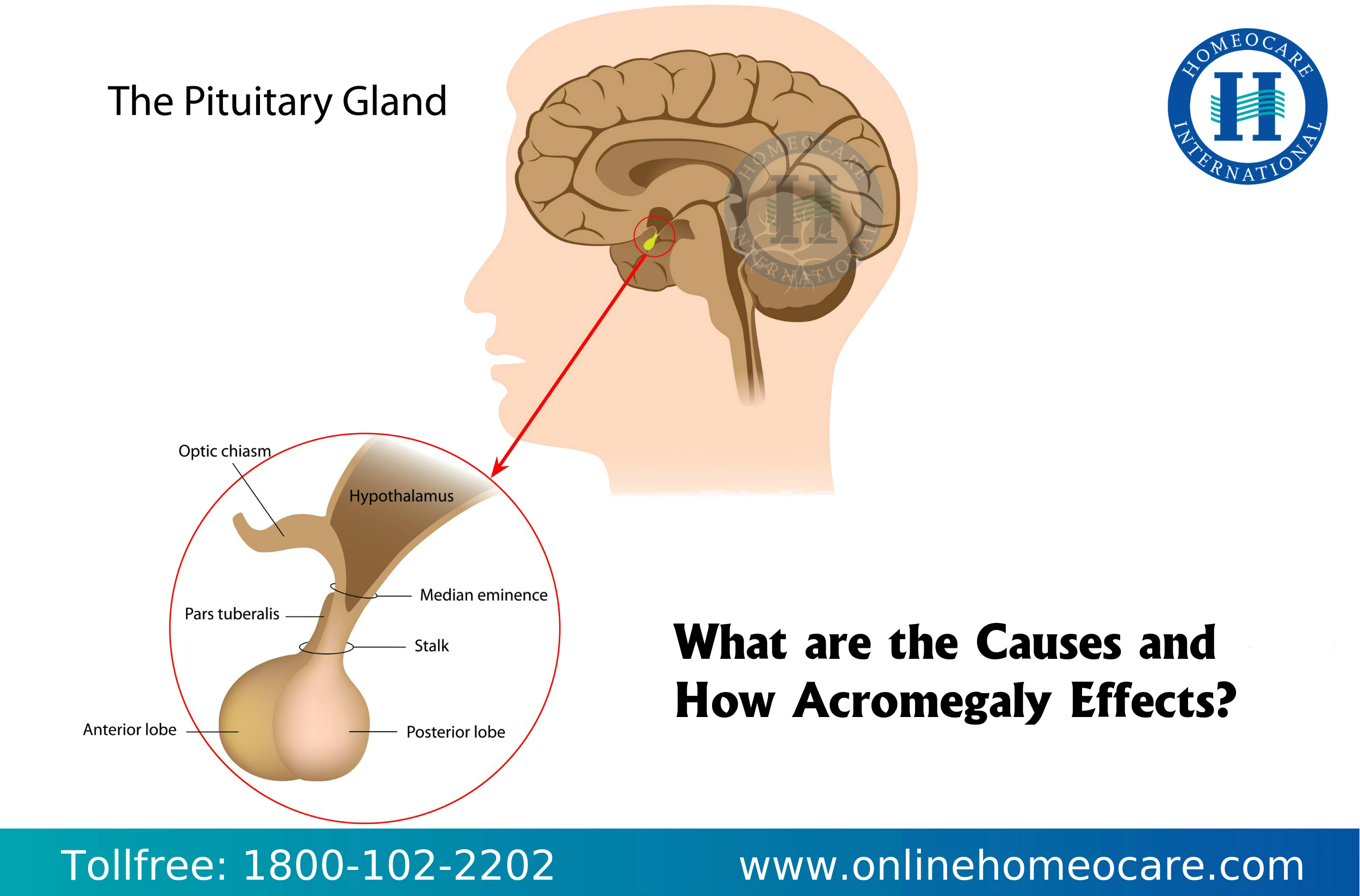 Causes of Acromegaly