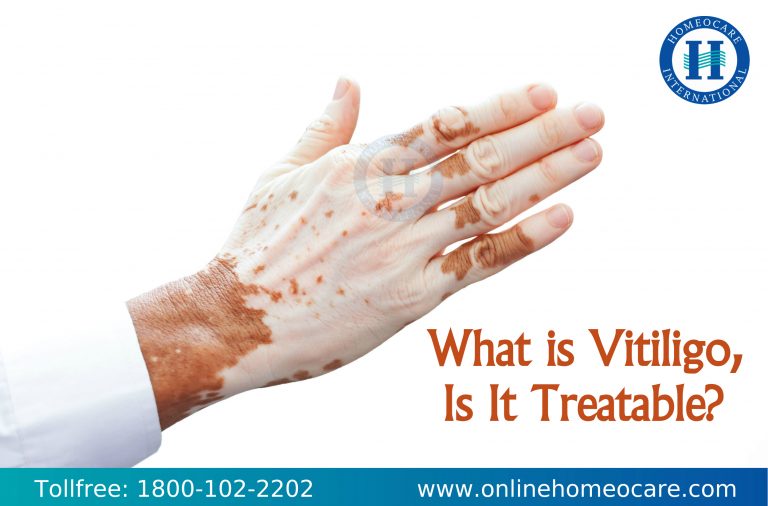 Causes of Vitiligo
