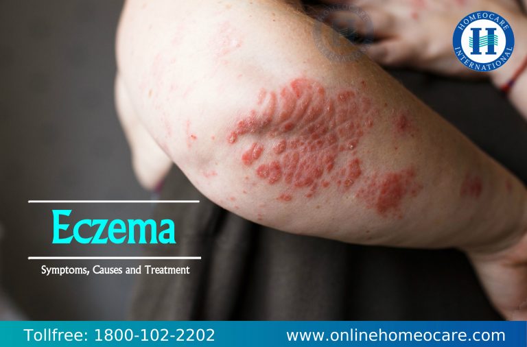 Symptoms of Eczema
