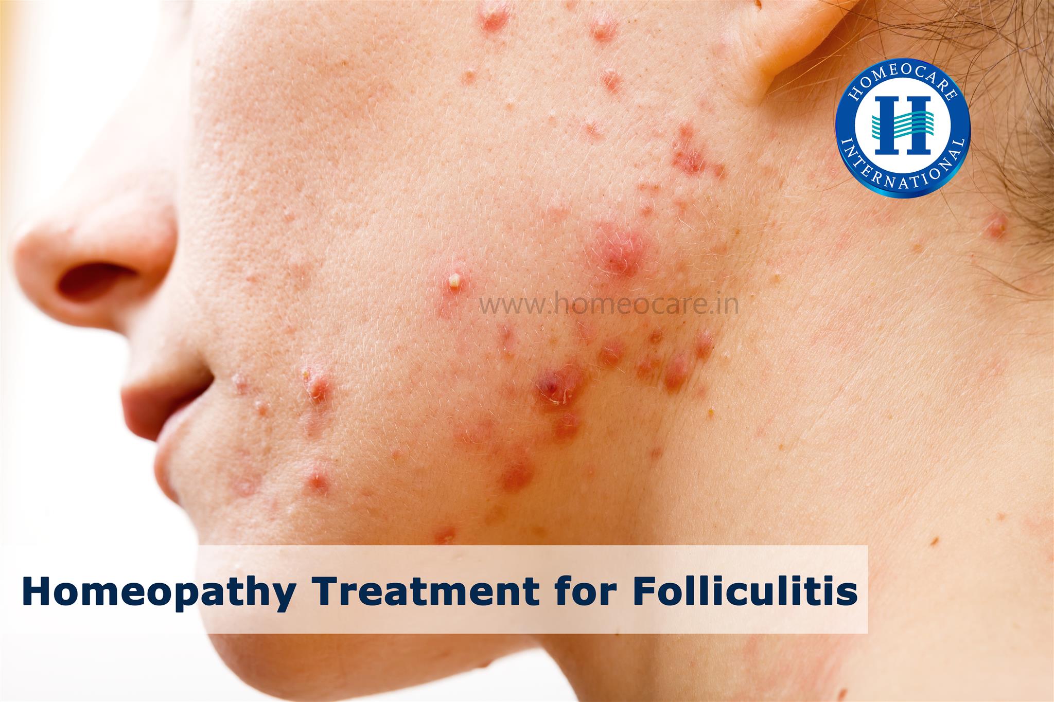 Homeopathy Treatment for Folliculitis