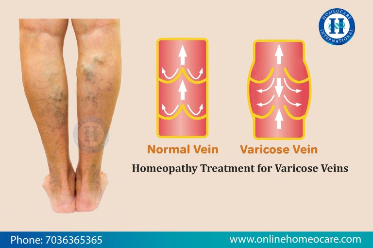 Homeopathy Treatment for Varicose Veins