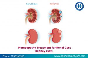 Kidney Treatment in Homeopathy