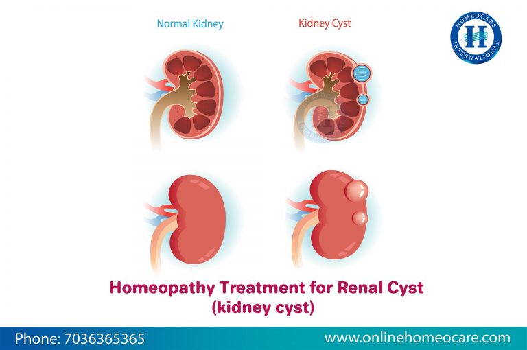 Kidney Treatment in Homeopathy